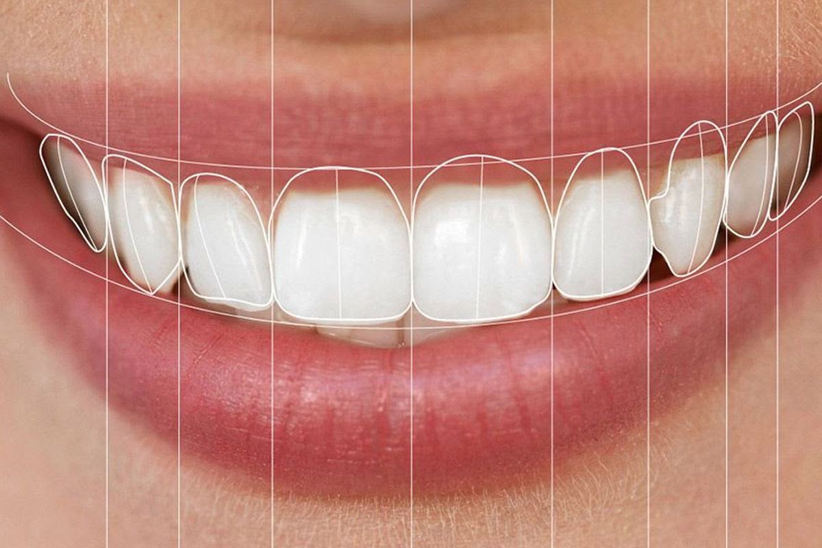 Diseño de sonrisa