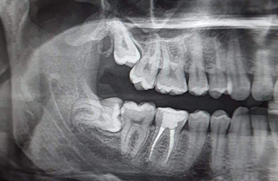 Cirugía de Tercera Molar