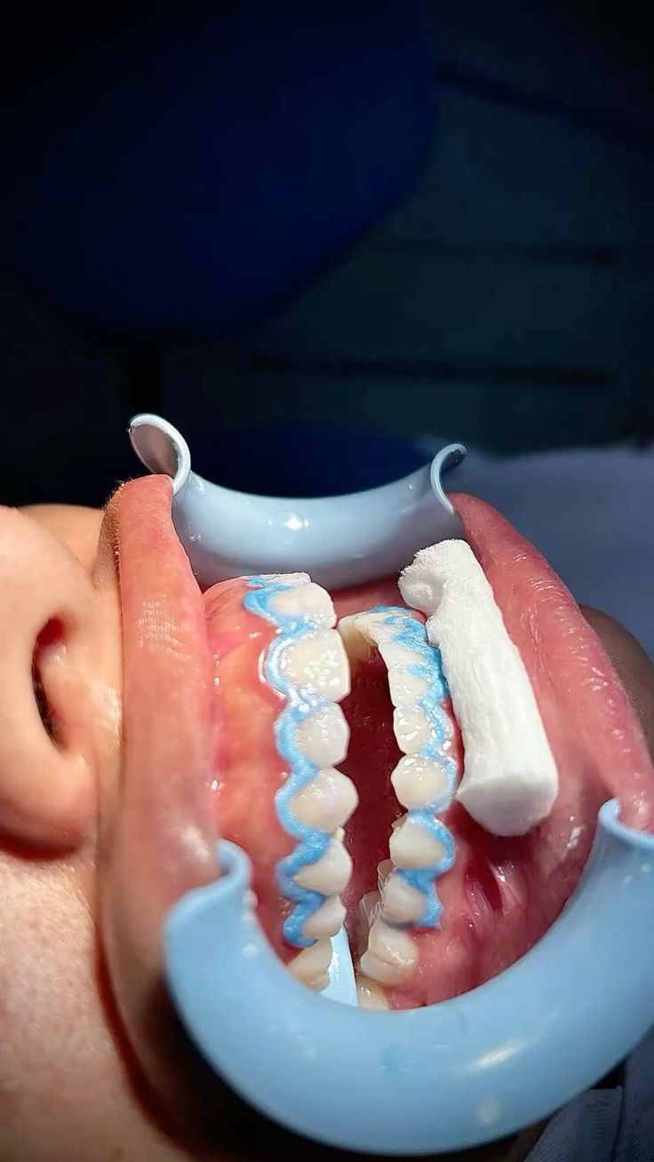Blanqueamiento dental